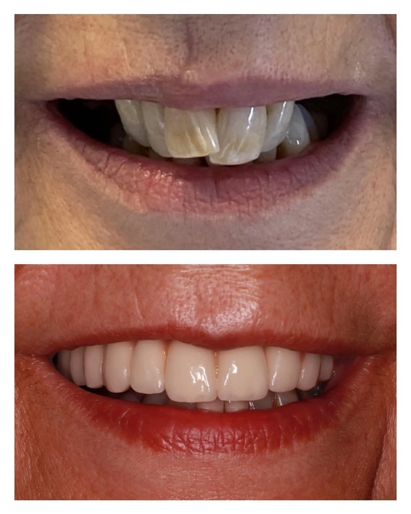 ad implantes dentales ad implantes dentales